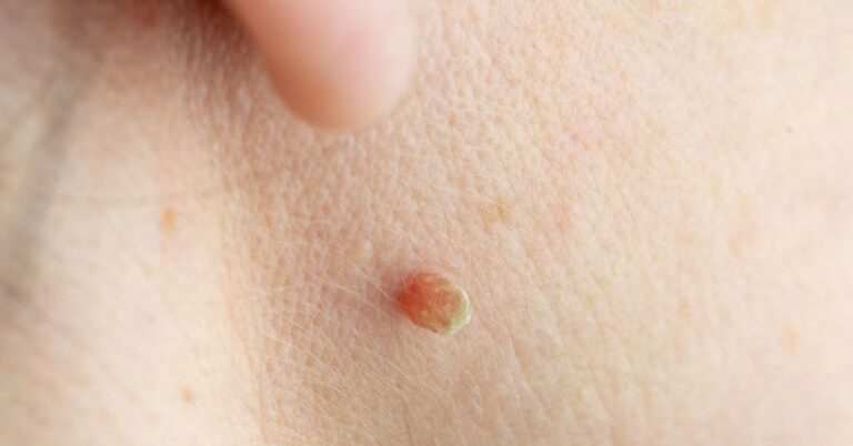 Anal Skin Tags