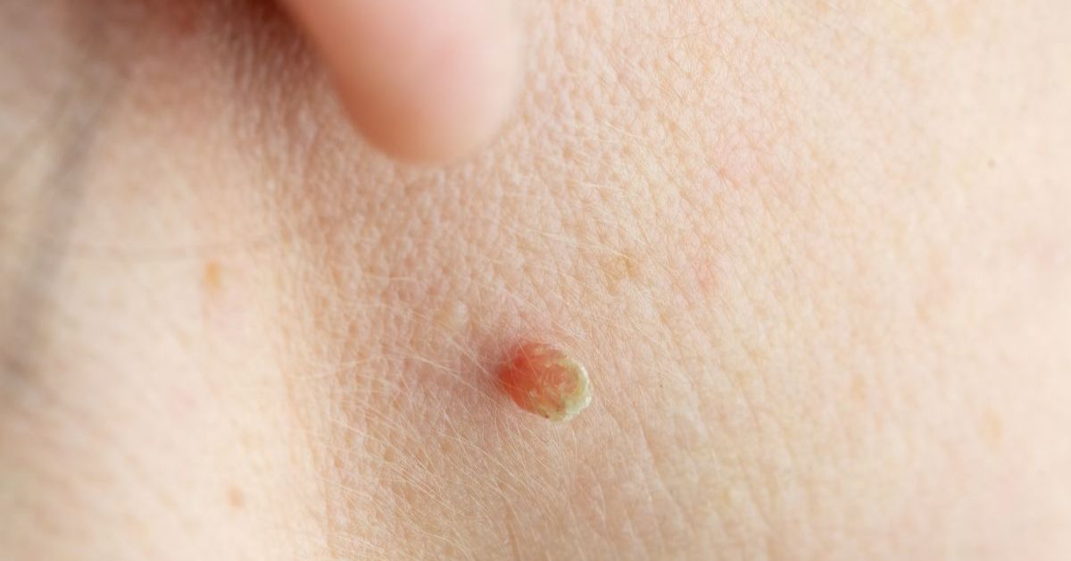Anal Skin Tags